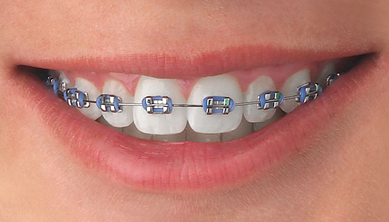 Brackets metálicos
