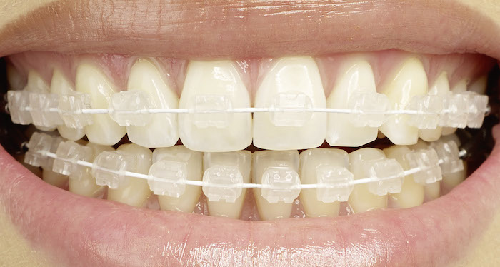 Brackets estéticos